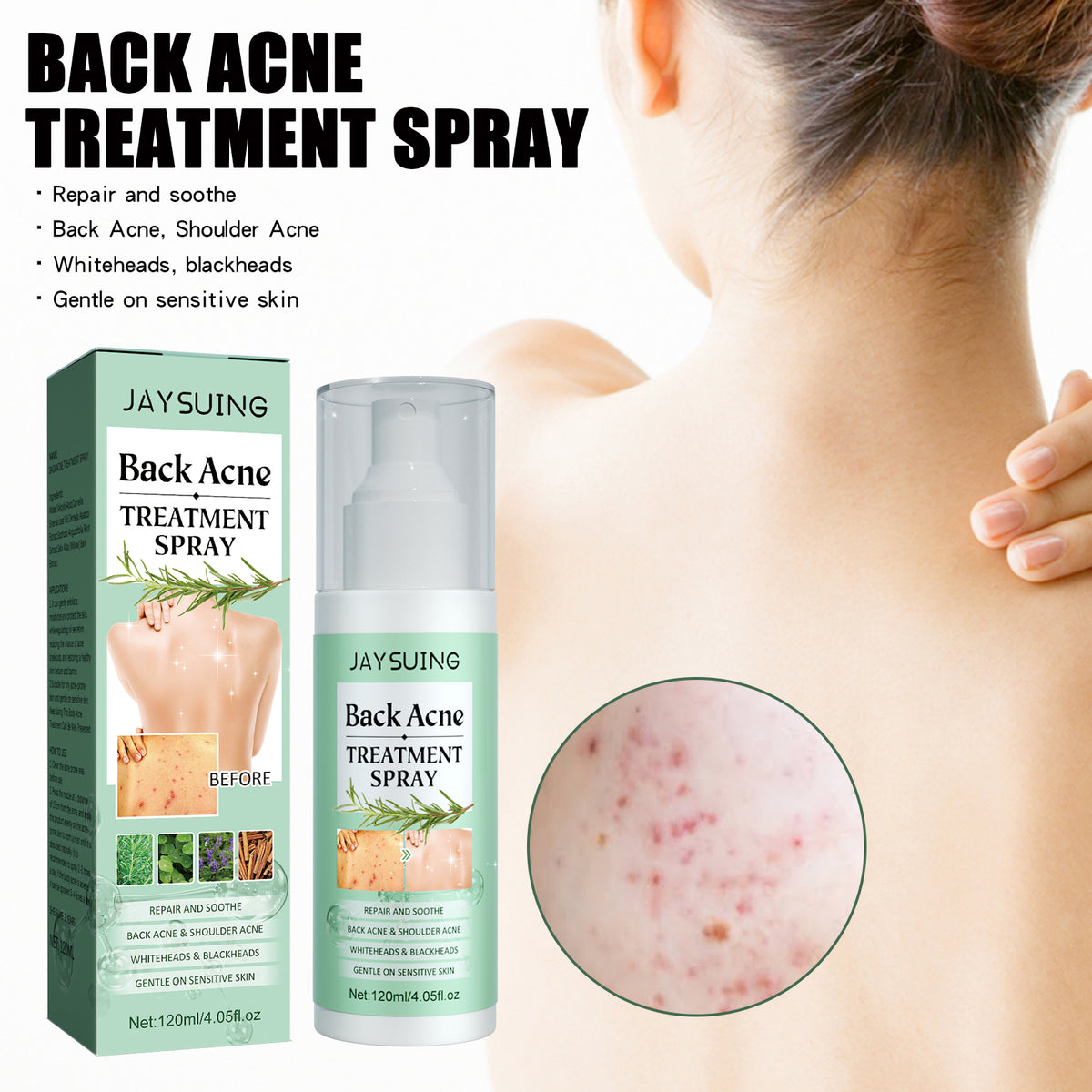 AcneAway Back Spray