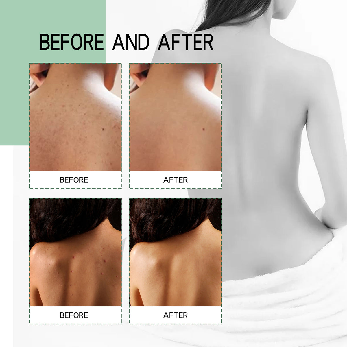 AcneAway Back Spray